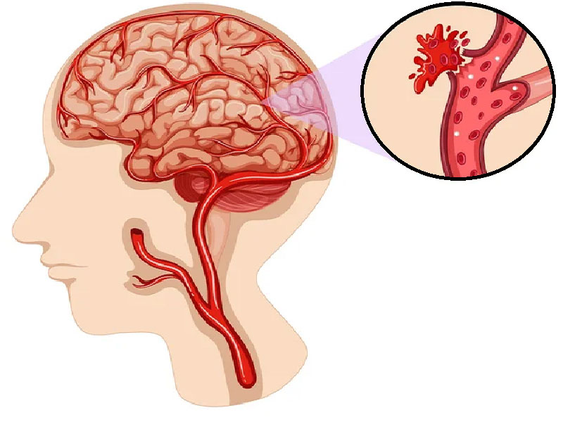 HEMORRAGIE CEREBRALE